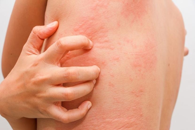 Skin Allergy and Home Remedies
